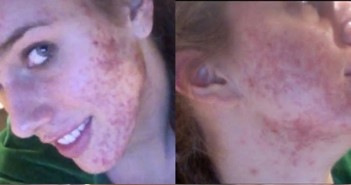 สิวเต็มหน้า ไม่ใช่ปัญหาความสวย ของ Cassandra Bankson นางแบบสาววัย20 acne-makeup-girl