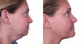 เคล็ดลับ กำจัดเหนียง ออกจากชีวิต ด้วยตัวเอง neck lift