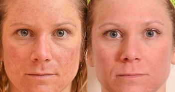 7 สูตรรักษาฝ้า ด้วยวิธีธรรมชาติ ที่คุณเองก็ทำได้! Melasma