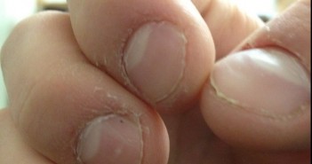 ชอบกัดเล็บ ดึงผม แกะแผล มีเกณฑ์เป็นพวกสมบูรณ์แบบเกินเหตุ! BITE-NAILS-02
